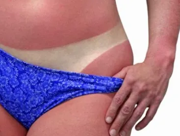 Россиян просят опасаться солнца